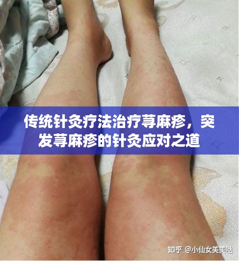 傳統(tǒng)針灸療法治療蕁麻疹，突發(fā)蕁麻疹的針灸應(yīng)對(duì)之道