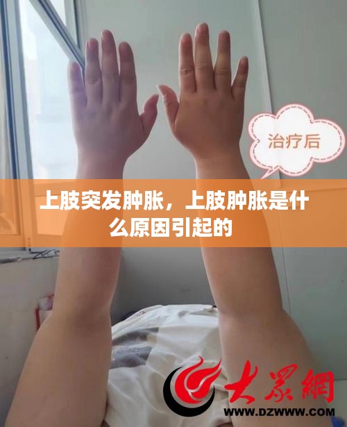 上肢突發(fā)腫脹，上肢腫脹是什么原因引起的 