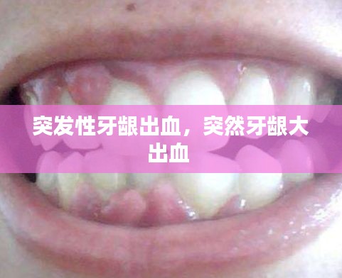 突發(fā)性牙齦出血，突然牙齦大出血 