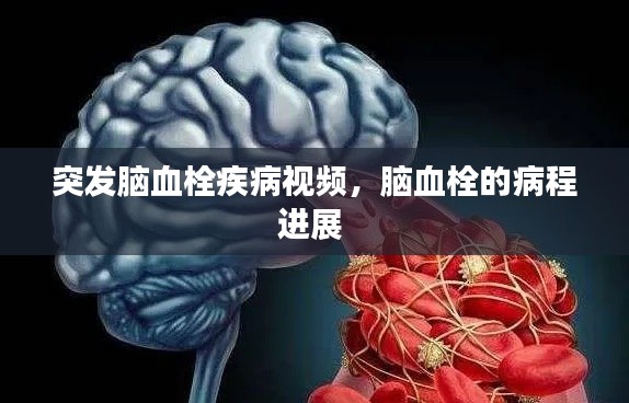 突發(fā)腦血栓疾病視頻，腦血栓的病程進展 