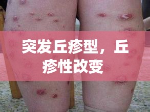 突發(fā)丘疹型，丘疹性改變 