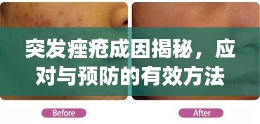 突發(fā)痤瘡成因揭秘，應(yīng)對與預(yù)防的有效方法