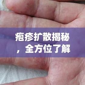皰疹擴(kuò)散揭秘，全方位了解、預(yù)防與治療指南